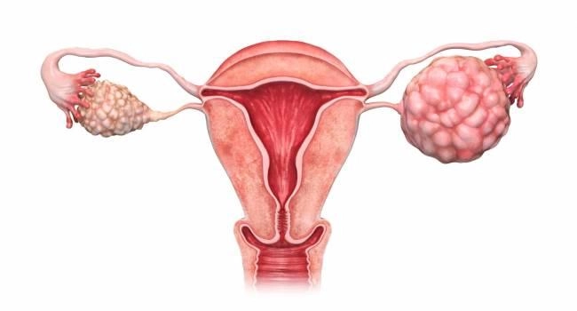 Imagen del artículo El cáncer de ovario supone el 2,9 % de todos los tumores en mujeres en la Comunitat Valenciana