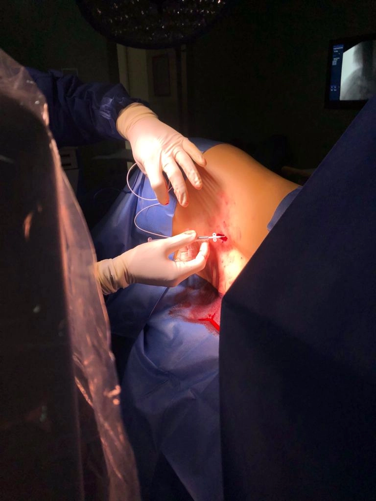 Imagen del artículo La Unidad de Dolor Crónico del Área de Salud Don Benito-Villanueva de la Serena, pionera en implantes intratecales