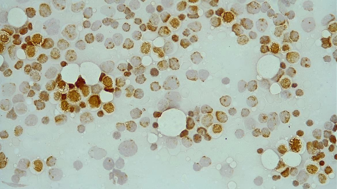 Imagen del artículo Las alteraciones de unas proteínas detectarían casos de leucemia mieloide aguda que no responden a la terapia estándar